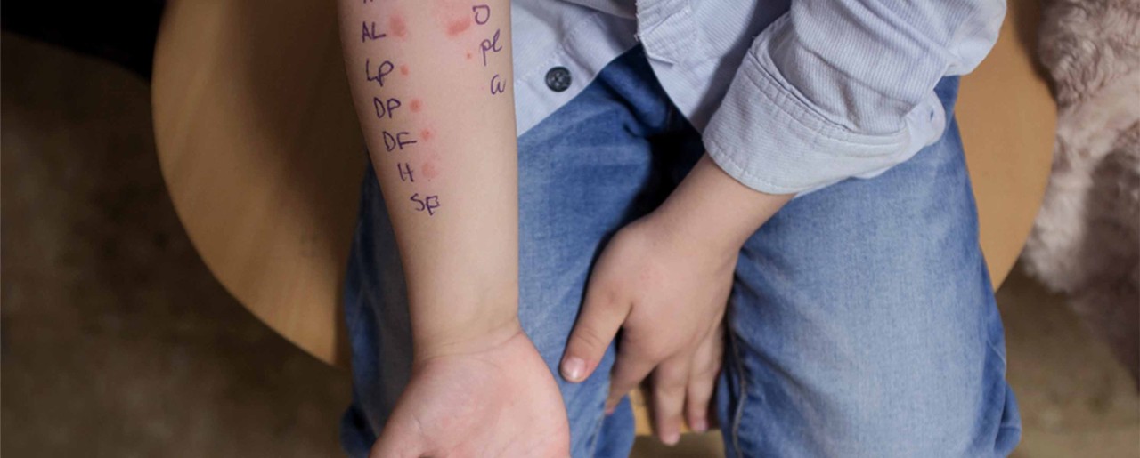 Kids arm with allergy test marks on it
